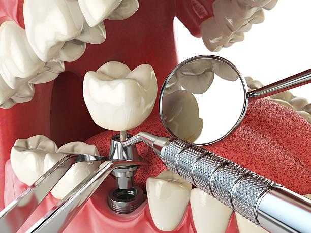 Best Broken or Chipped Tooth Repair in Cheviot, OH